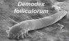 Demodex Mites’ Role in Chronic Dry Eye Explained