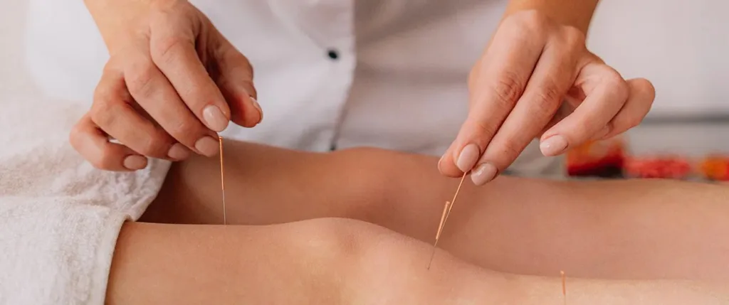 Acupuncture for Stress Relief: Essential Guide to Ease Anxiety