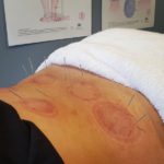 Sports Recovery Acupuncture: 6 Key Benefits to Know